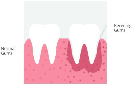 causes of tooth sensitivity causes-of-tooth-sensitivity