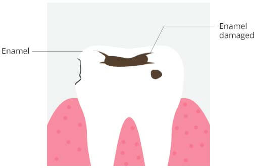 causes-of-tooth-sensitivity